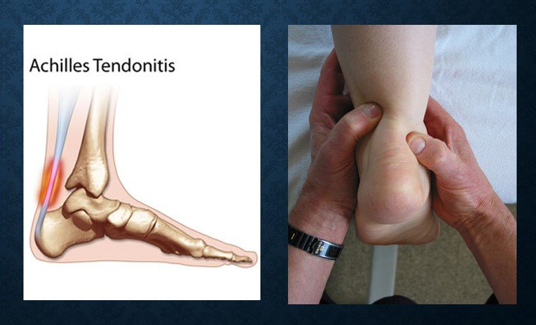 Achilles tendonitis